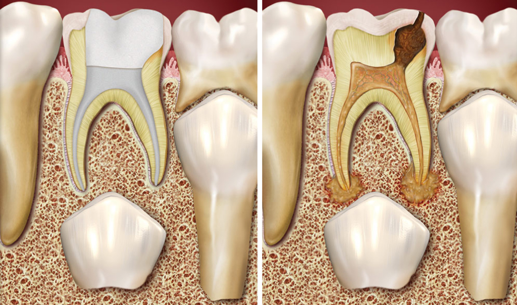 Если не лечить временные зубы, они могут стать причиной повреждения постоянных