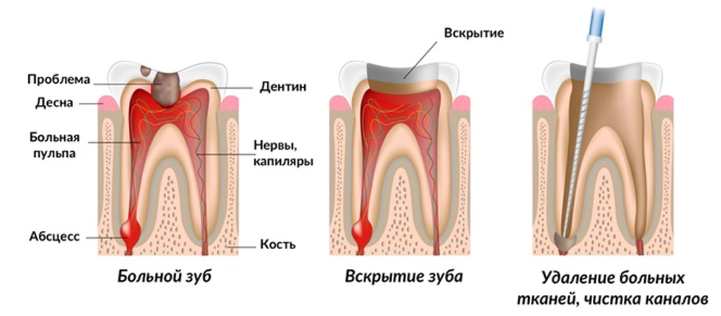 Процесс лечения зубов