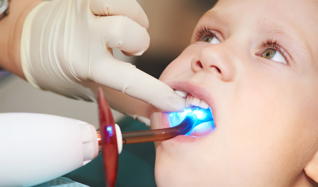 Так проходит пломбирование зубов у ребенка светоотражающими композитами