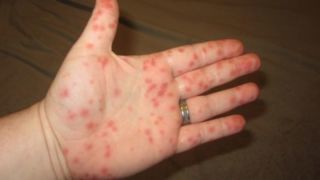 Энтеровирусная инфекция на руках