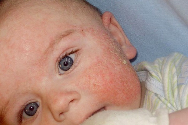 Аллергия на лице у новорожденного