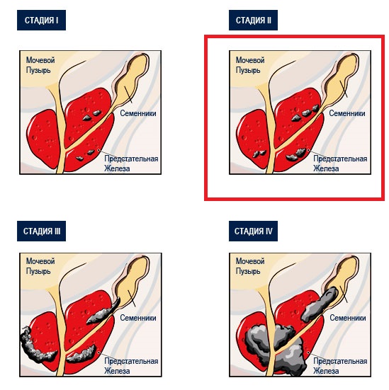 Стадии рака простаты. Онкология простаты стадии. Стадии онкологии предстательной железы. Онкология простата вторая степень.