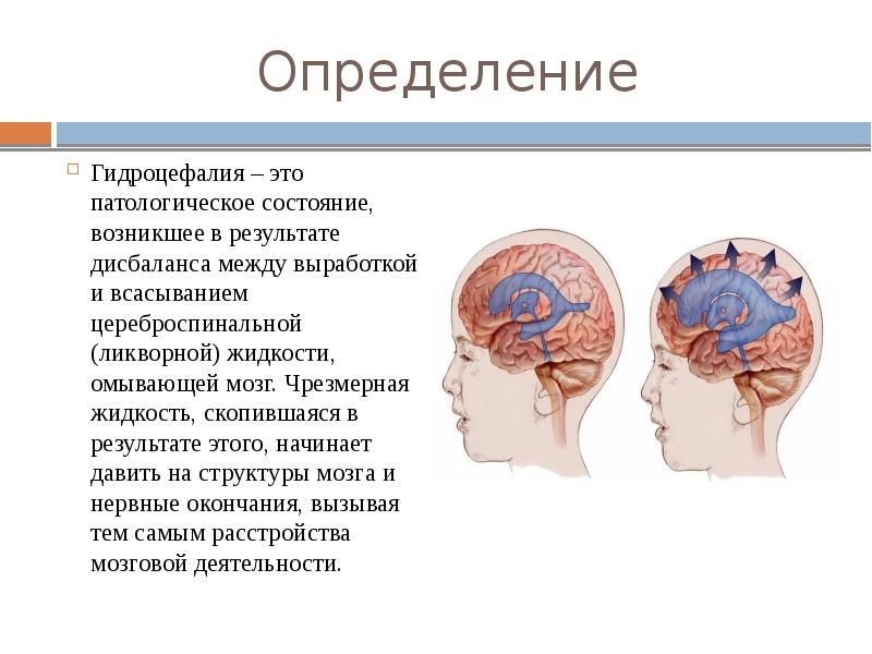 Причины гидроцефалии мозга. Гидроцефалия клинические проявления. Гидроцефалия головного мозга симптомы.