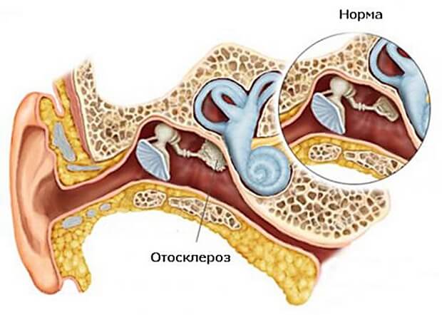 Отосклероз