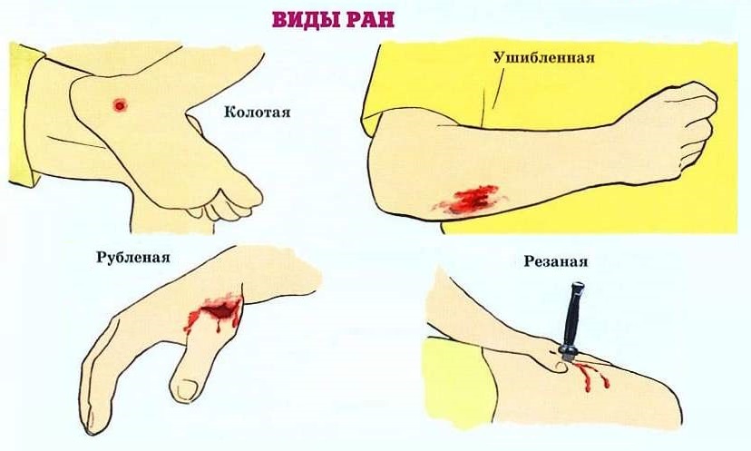 Виды ран и их описание