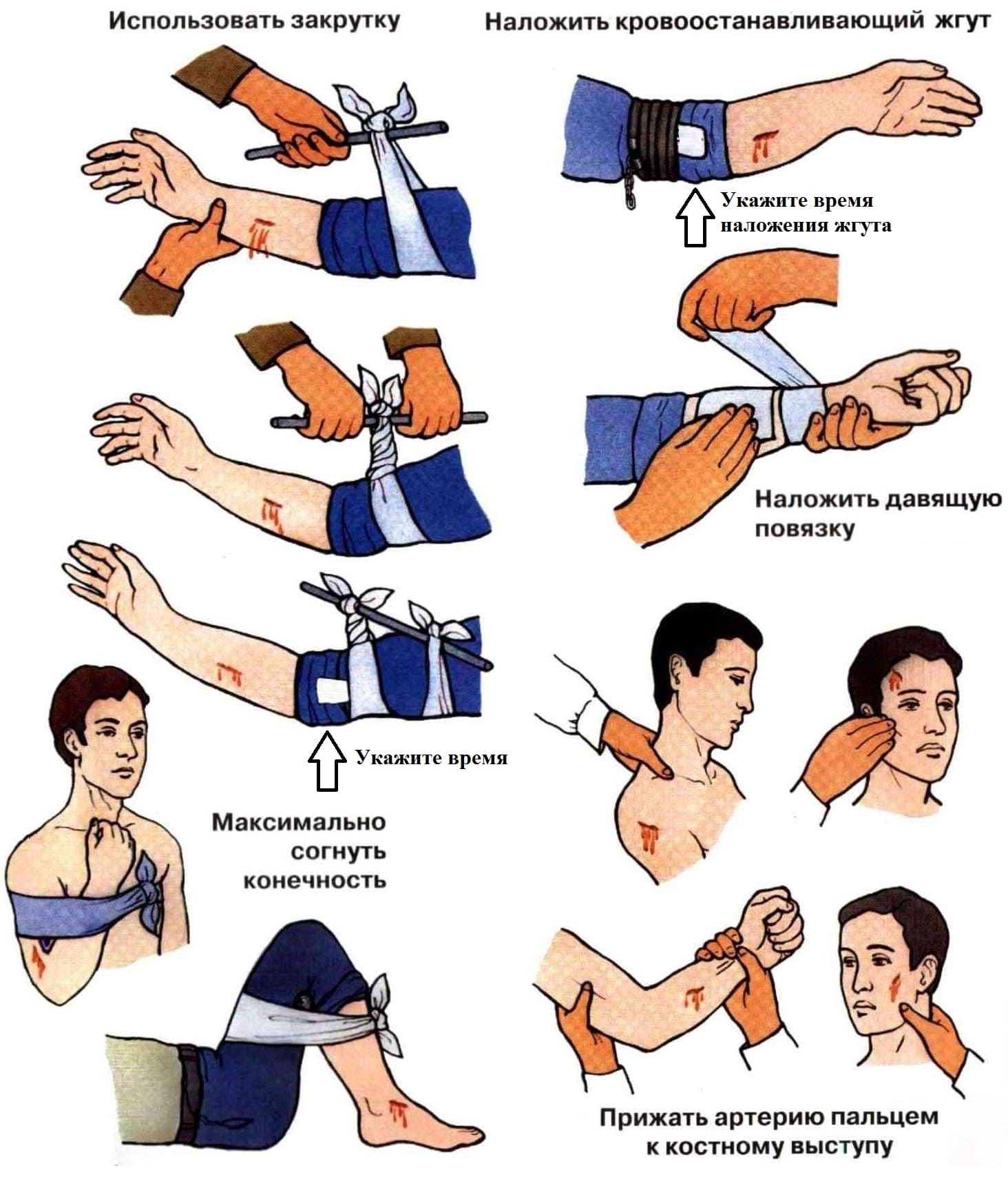 Временная остановка кровотечения