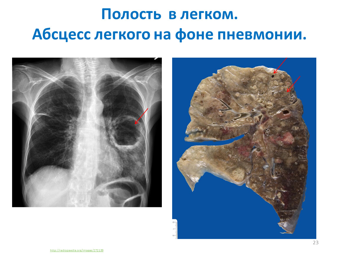 Гнойные абсцессы легких. Долевая пневмония макропрепарат. Пневмониогенный абсцесс легкого. Синдром полости в легочной ткани рентген.
