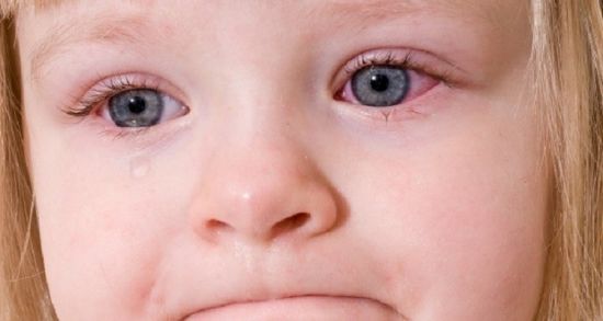 Красные глаза у ребенка