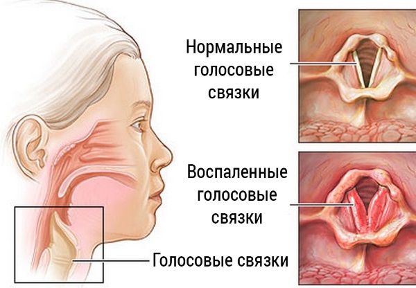 Ларингит у детей. Симптомы и лечение в домашних условиях. Фото горла, как лечить острый, хронический, аллергический