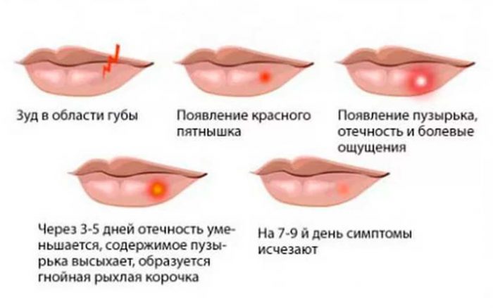 Герпес на губах у ребенка. Причины, симптомы, как лечить народными средствами, препараты