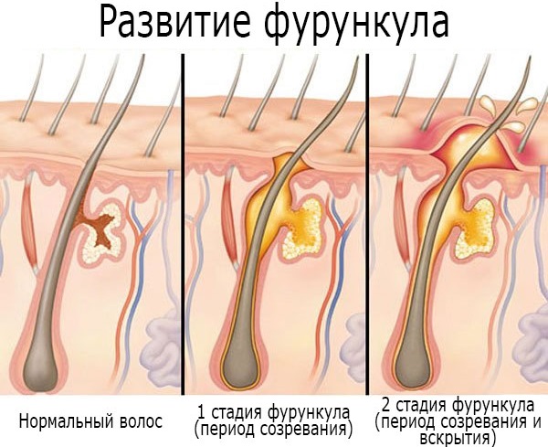 Уплотнение в виде шариков под кожей в паху, под мышкой, на шее, подбородке, щеке, спине. Что это, лечение