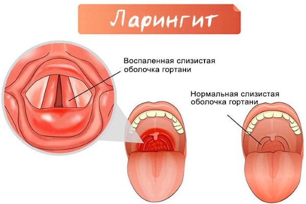 Гортань и глотка. Анатомия, строение, функции, заболевания