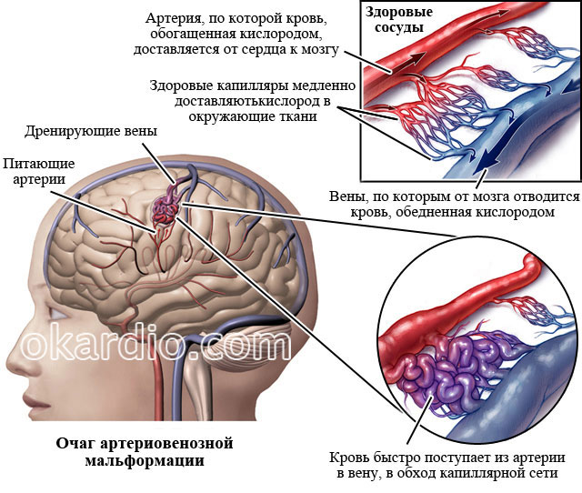 Инсульт левой артерии. Мальформация сосудов головного. Артериовенозная мальформация мозга. Венозная мальформация головного мозга. Артериовенозные мальформации (АВМ) головного мозга..