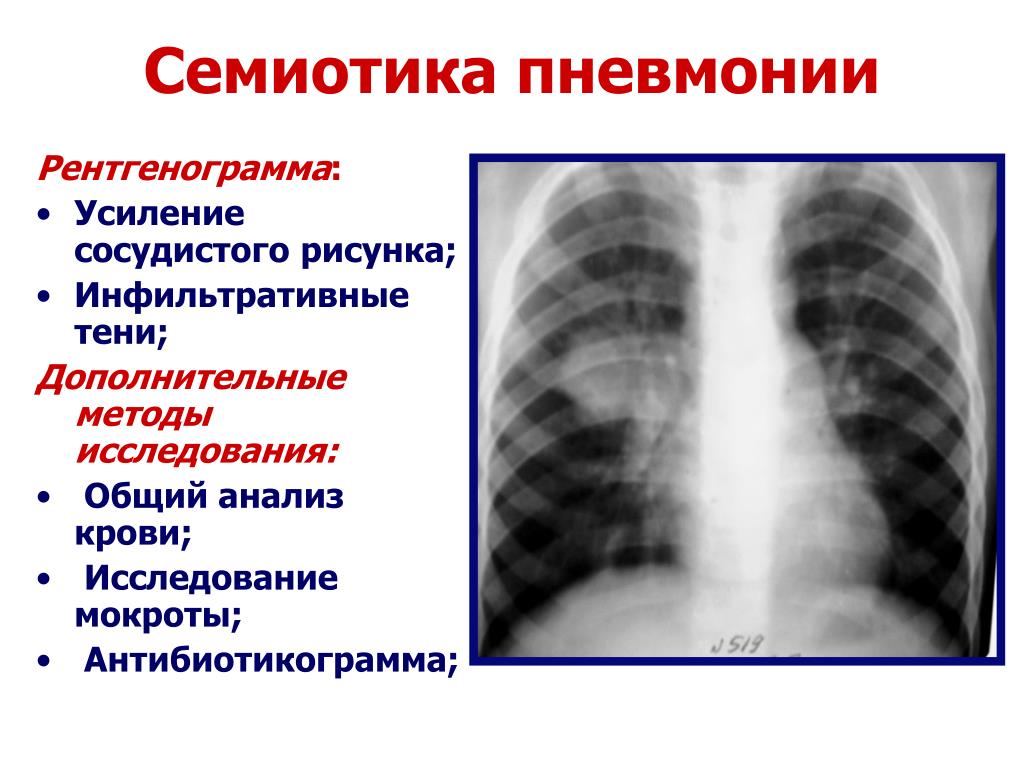 Легочный рисунок при пневмонии