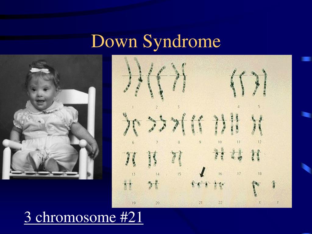 50 chromosome. Трисомия по 21 хромосоме кариотип. Трисомия по 16 хромосоме.