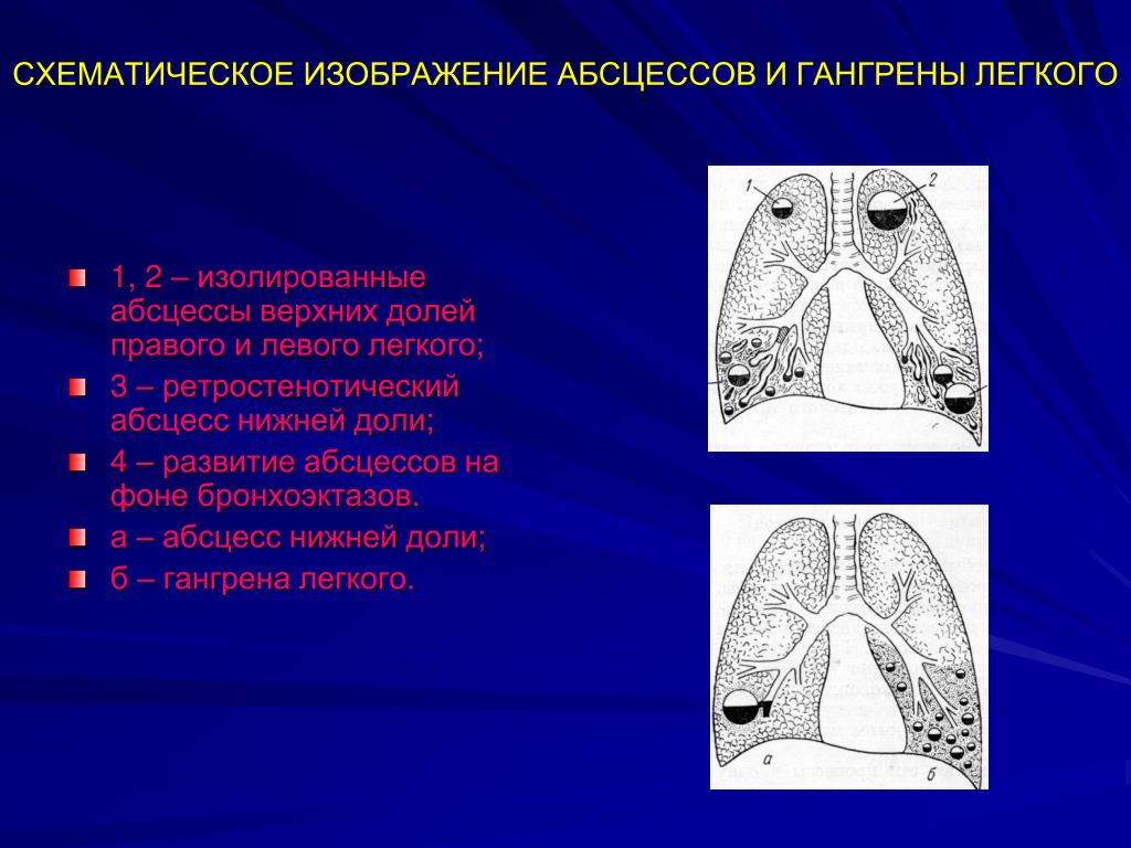 Абсцесс легкого. Формирование абсцесса легкого. Локализация абсцесса легких. Гангрена верхней доли левого легкого.