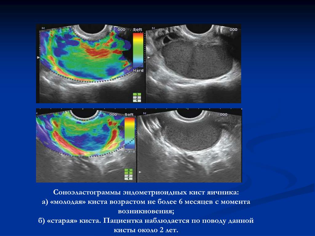 Что значит киста. Эндометриоидная киста яичника клиника. Эндометриоидная киста яичника диагноз. Эндрометриоитднаякиста яичника. Яичник с эндометриоидной кистой.