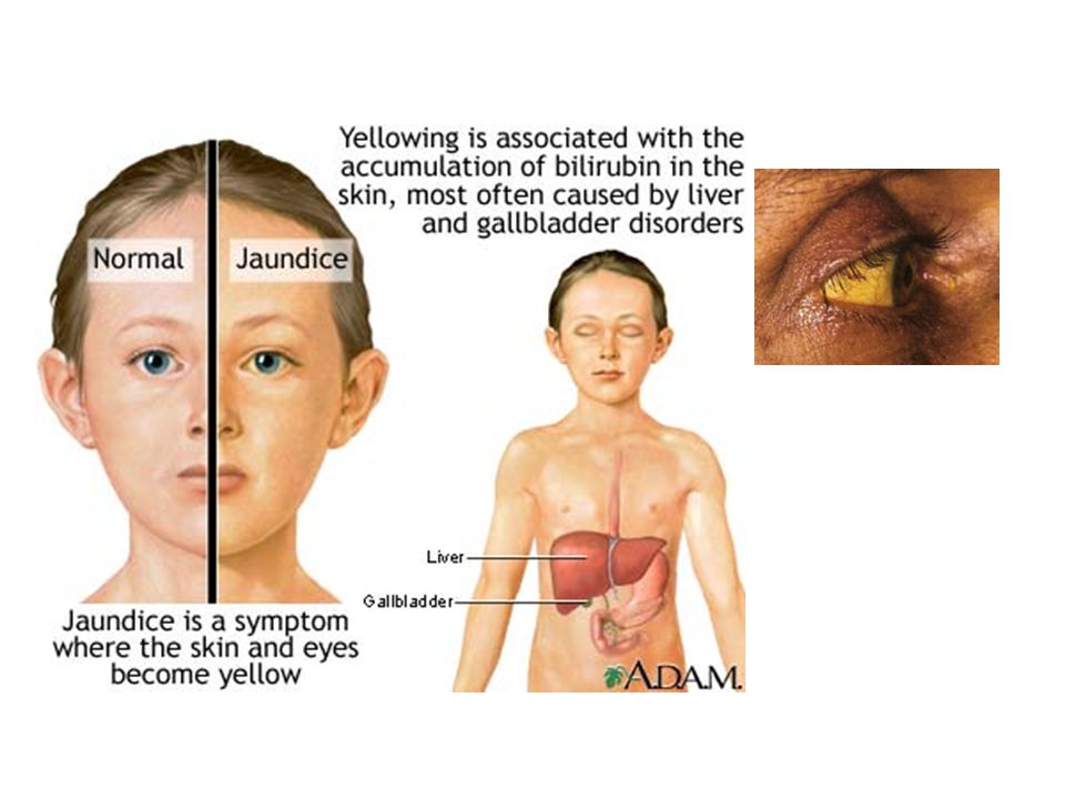 Желтуха симптомы у детей. Желтушный синдром у детей.