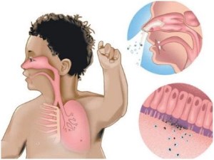 Как вылечить лающий кашель у детей