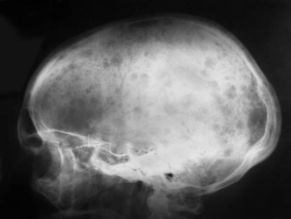 Очаговые изменения костей. Миеломная болезнь рентген черепа. Остеома костей черепа рентген. Остеопороз черепа рентген. Миеломная болезнь кости черепа рентген.