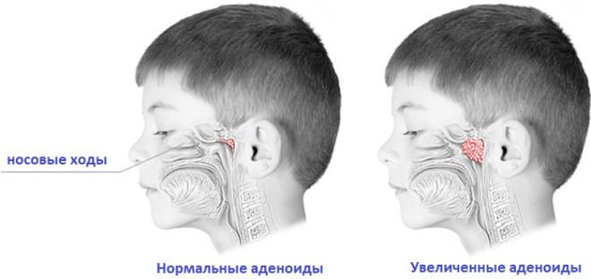 что такое аденоиды