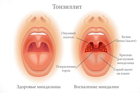 Острый тонзиллит