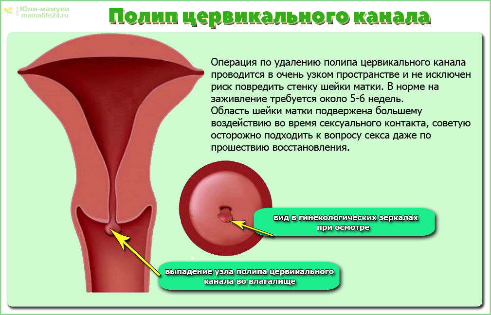 Полип шейки матки удаление. Полип цервикального канала. Полип в церикальном канал. Полип эндометрия и цервикального канала. Полипцырвикального канала.