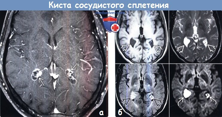 Киста сосудистого сплетения. Нейросонография кисты сосудистого сплетения. Кисты боковых желудочков мозга мрт. Кисты сосудистых сплетений боковых желудочков мрт. Ксантогранулема сосудистого сплетения мрт.