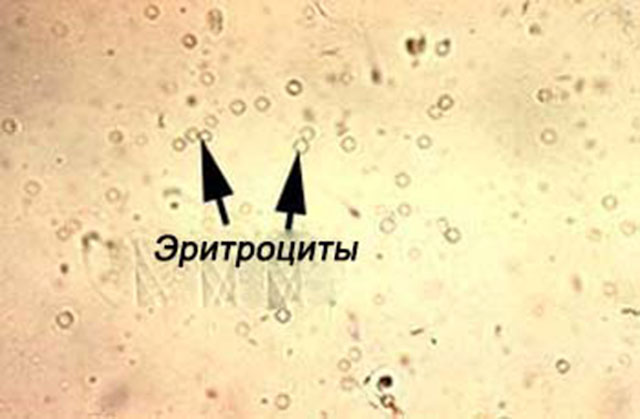 Эритроциты в моче. Эритроциты в моче под микроскопом. Микроскопия мочи эритроциты. Лейкоциты и эритроциты в моче под микроскопом. Моча по Нечипоренко микроскопия.