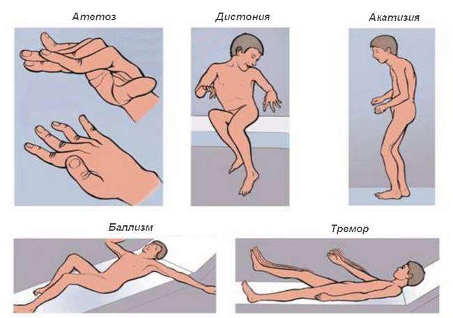 Непроизвольные движения. Гиперкинетический гипотонический синдром. Гиперкинез атетоз синдром.