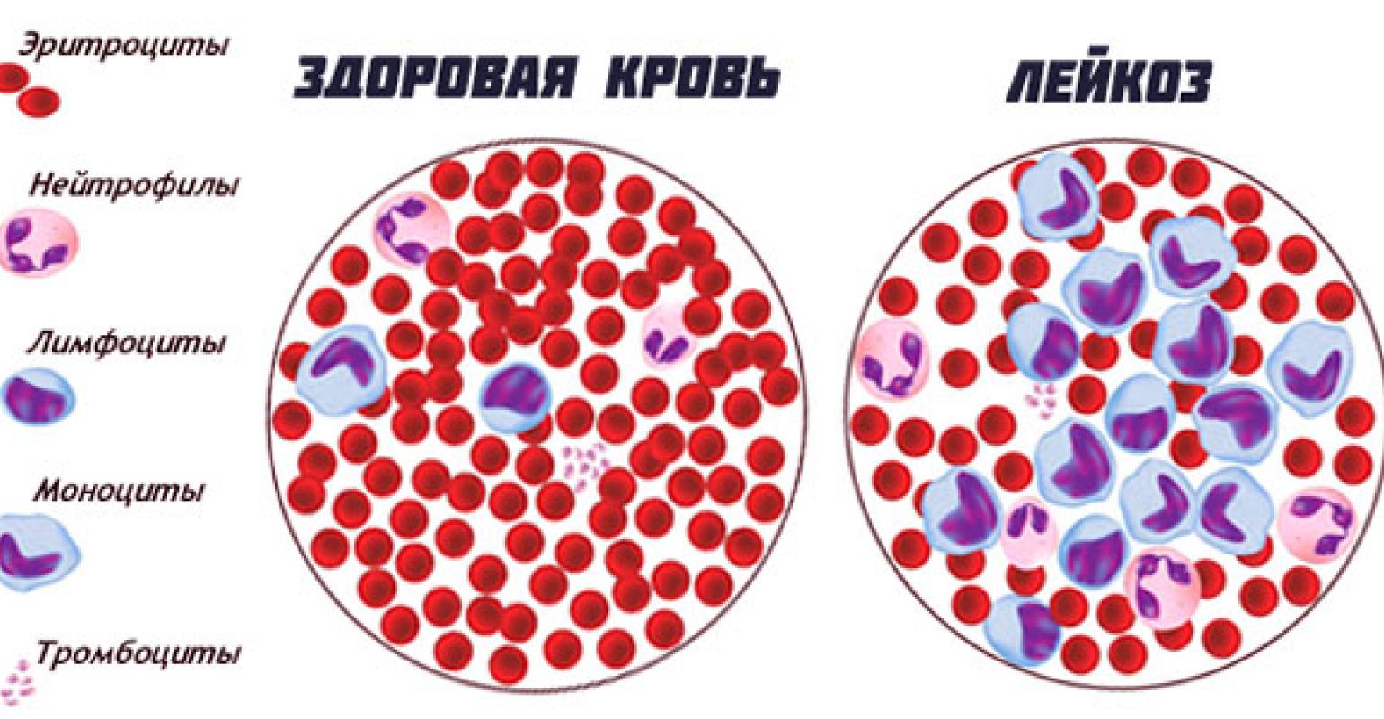 Клетки при лейкозе