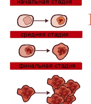 Стадии лейкоза