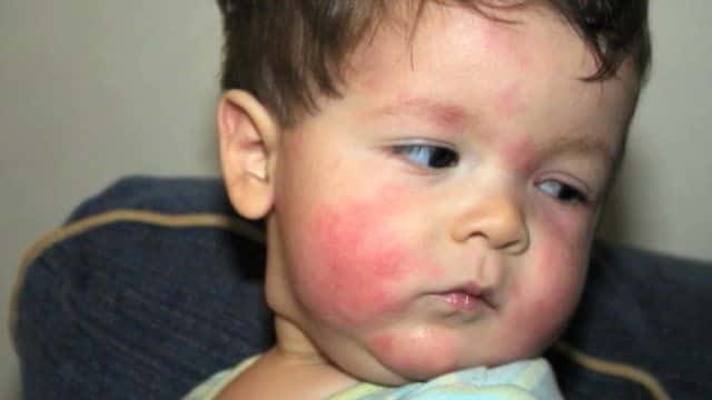 аллергия на мед у ребенка