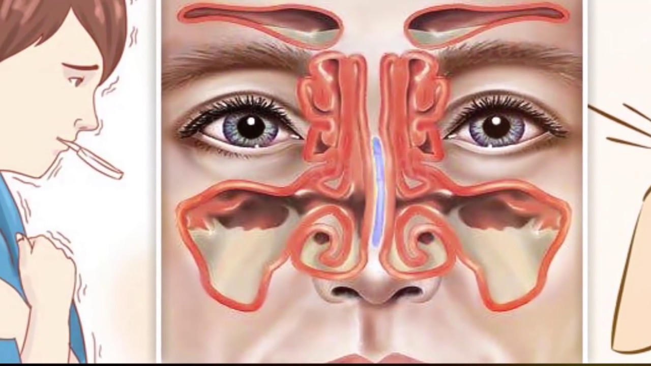 Почему течет нос при простуде. Острый катаральный синусит. Катаральный верхнечелюстной синусит. Вазомоторный ринит риноскопия.