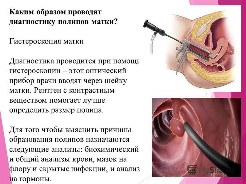 Как диагностируют полипы