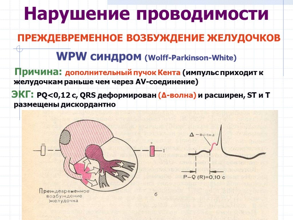 Ранний желудочков. Синдром преждевременного возбуждения желудочков. Синдром преждевременного возбуждения желудочков на ЭКГ. Преждевременное возбуждение желудочков на ЭКГ. ВПВ синдром нарушение проводимости.