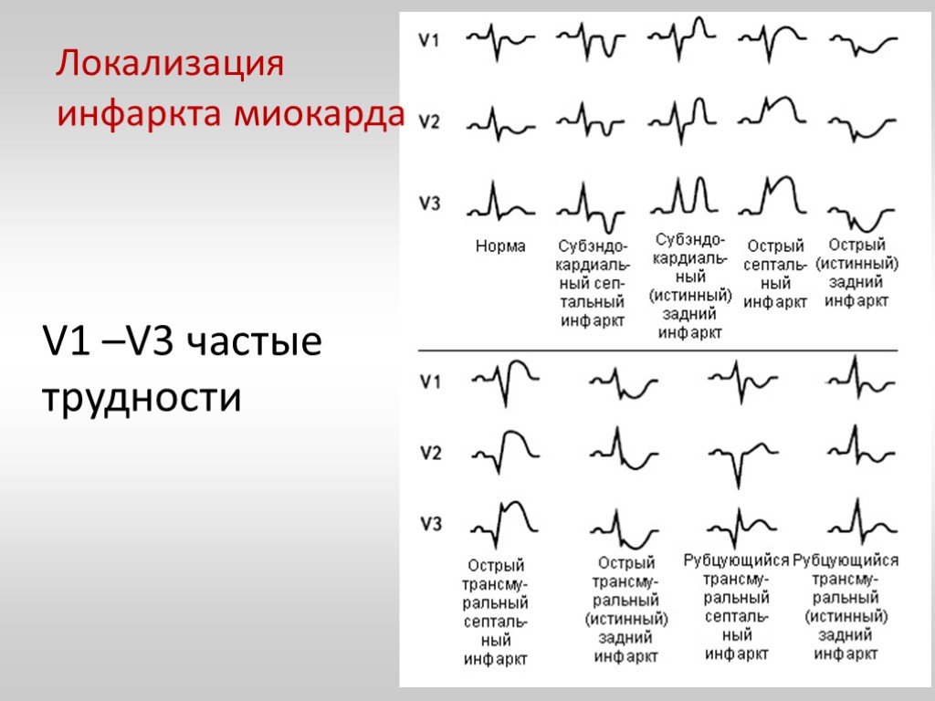 Отведение v1 на экг. Острый инфаркт миокарда ЭКГ расшифровка. Острейший период инфаркта миокарда на ЭКГ. ЭКГ плёнки инфаркта миокарда по локализации. Инфаркт миокарда ЭКГ v1 v2 v3.