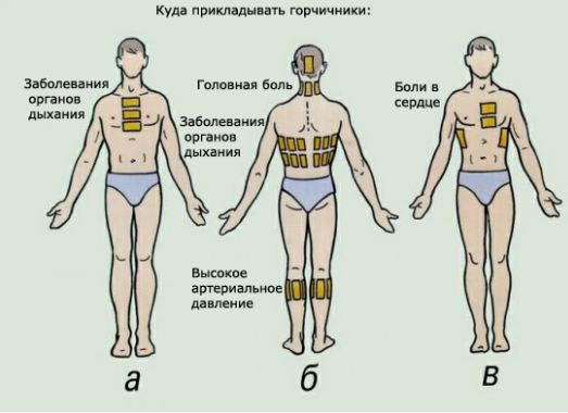 Как правильно поставить горчичники