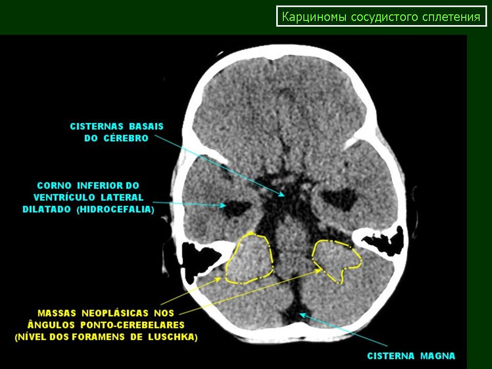 Шишковидная железа обызвествление. Ксантогранулема сосудистого сплетения кт. Обызвествление сосудистых сплетений. Карцинома сосудистого сплетения.