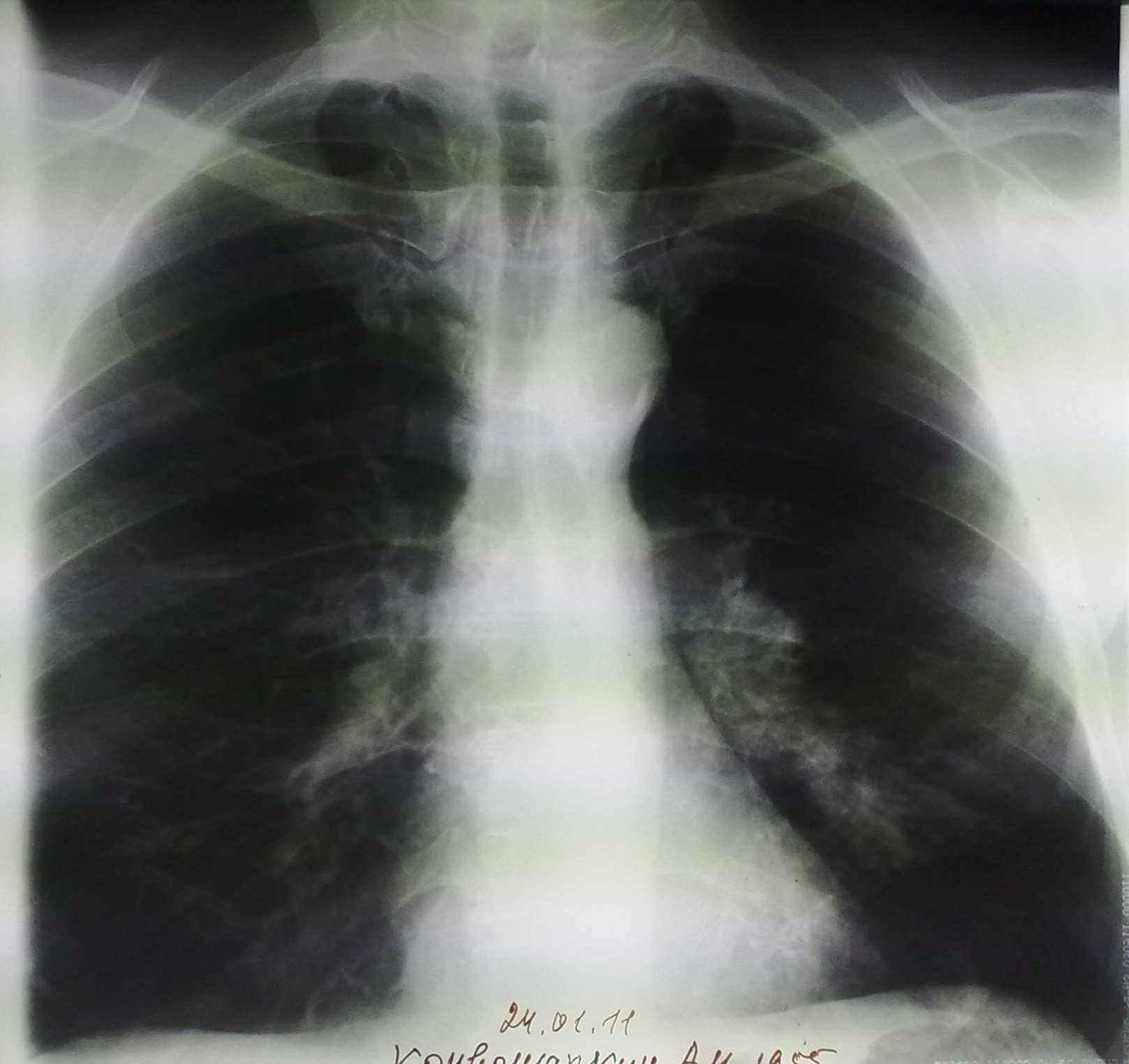 Вода в легких последствия. Линейный фиброз рентген. Пневмосклероз рентгенограмма. Тотальный пневмосклероз. Пневмофиброз лёгких на рентгене.
