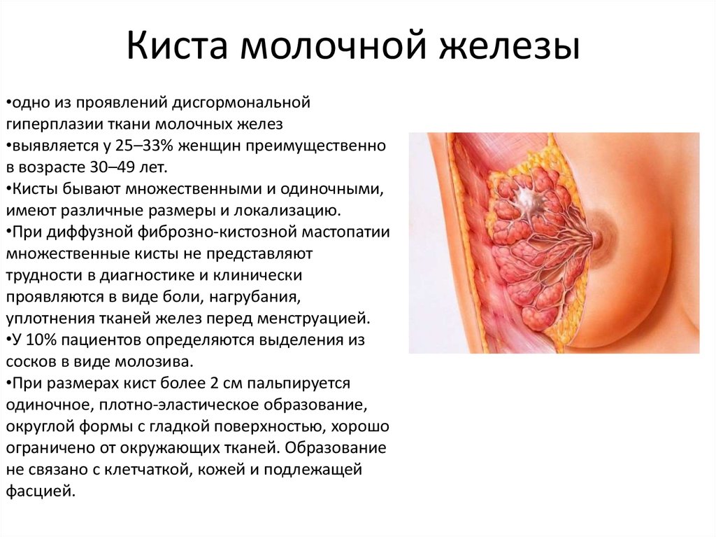 Киста молочной железы лечение. Что такое киста молочной железы у женщин. Киста молочной железы симптомы. Киста в грудной железе у женщин.