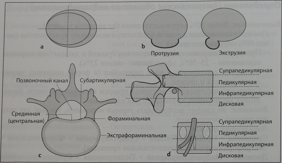 Парамедианная экструзия. Выбухание дисков позвонков кт. Классификация грыж межпозвонковых дисков мрт. Классификация протрузий межпозвонковых дисков. Классификация экструзии межпозвонковых дисков.