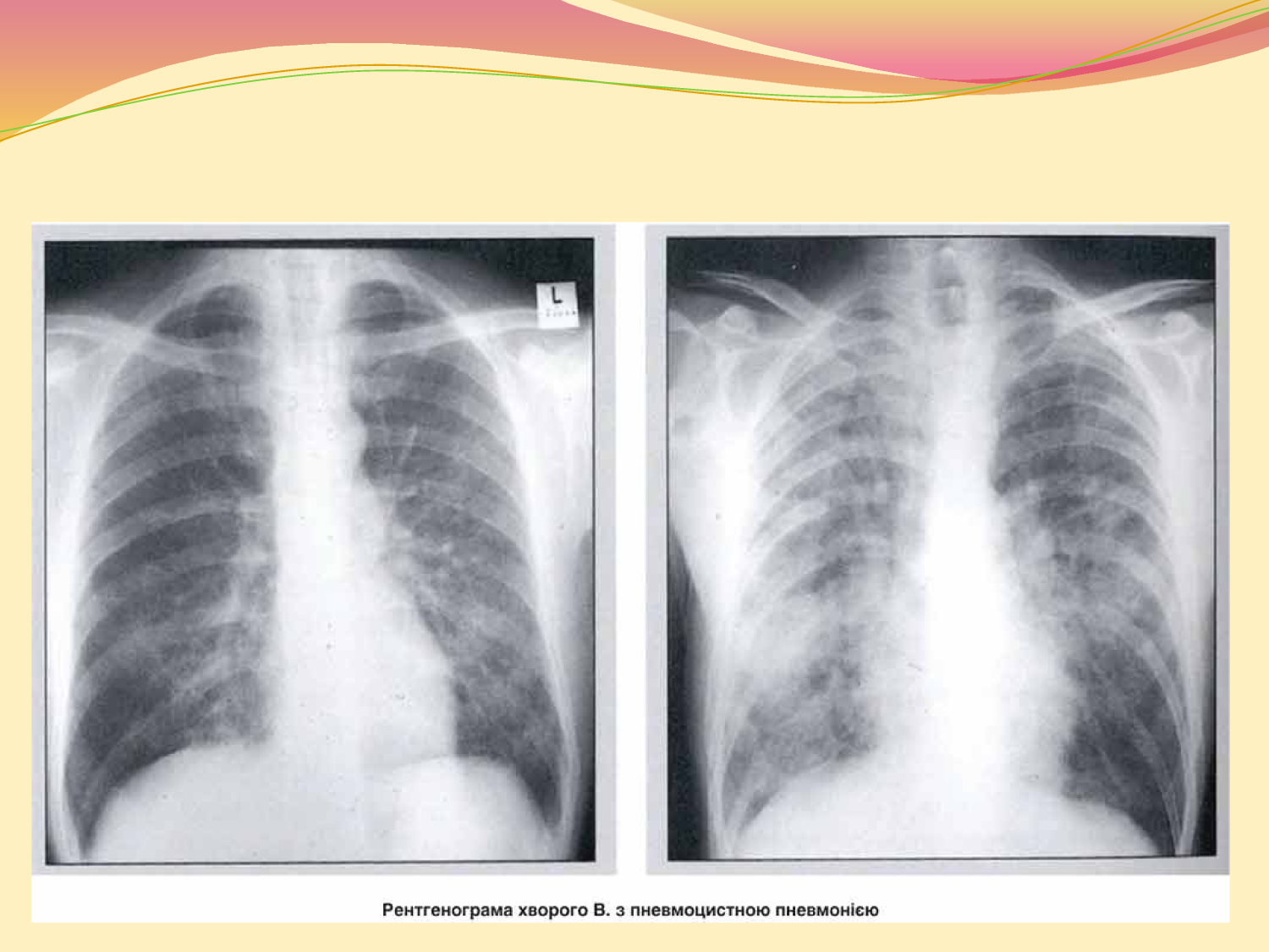 Поражения правого легкого. Левосторонняя полисегментарная пневмония рентген. Правосторонняя очаговая пневмония рентген. Правосторонняя полисегментарная пневмония рентген. Очаговая сегментарная долевая пневмония.