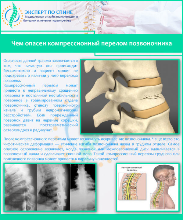 Чем опасен компрессионный перелом позвоночника