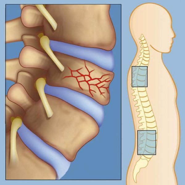 Компрессионный перелом поясничного отдела
