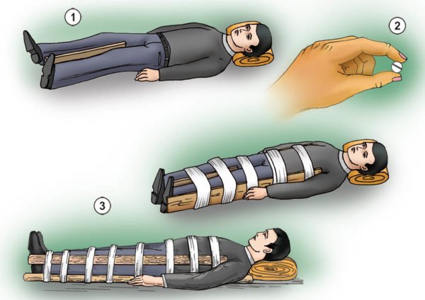 Помощь при переломе позвоночника