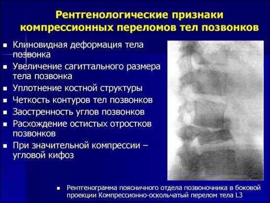 Рентген при компрессионном переломе позвоночника