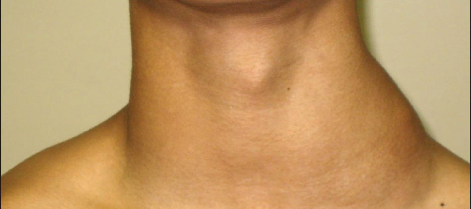 воспаление лимфоузлов на груди у женщин фото 74