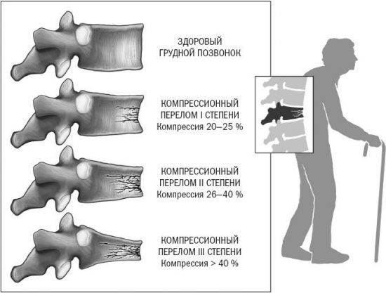 Виды переломов позвоночника