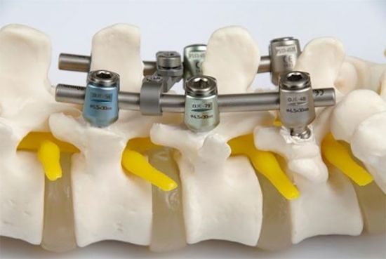 Фиксация позвоночника металлическими винтами